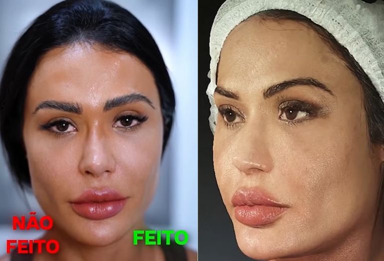 Gracyanne Barbosa mostrando a diferença entre antes de depois do procedimento, mostrando o rosto com aparência mais natural e pele iluminada